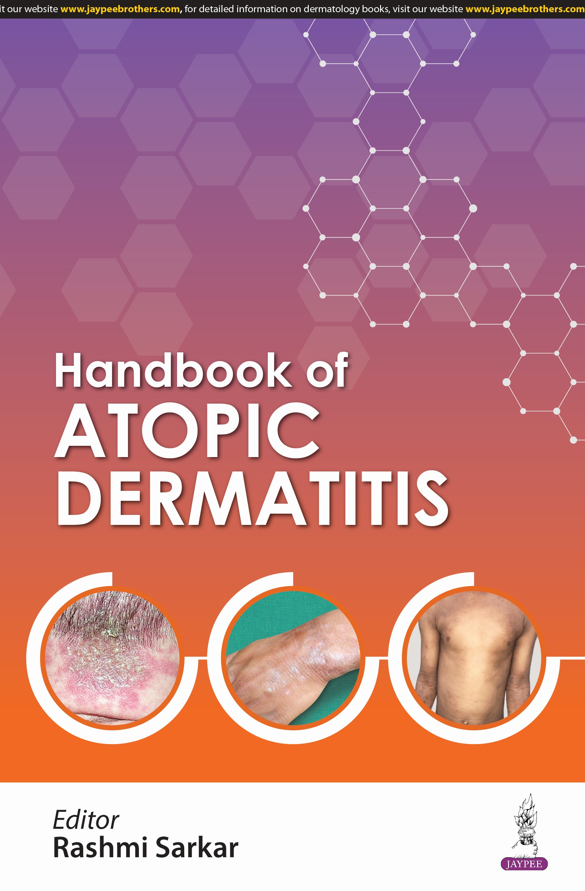 Handbook of Atopic Dermatitis