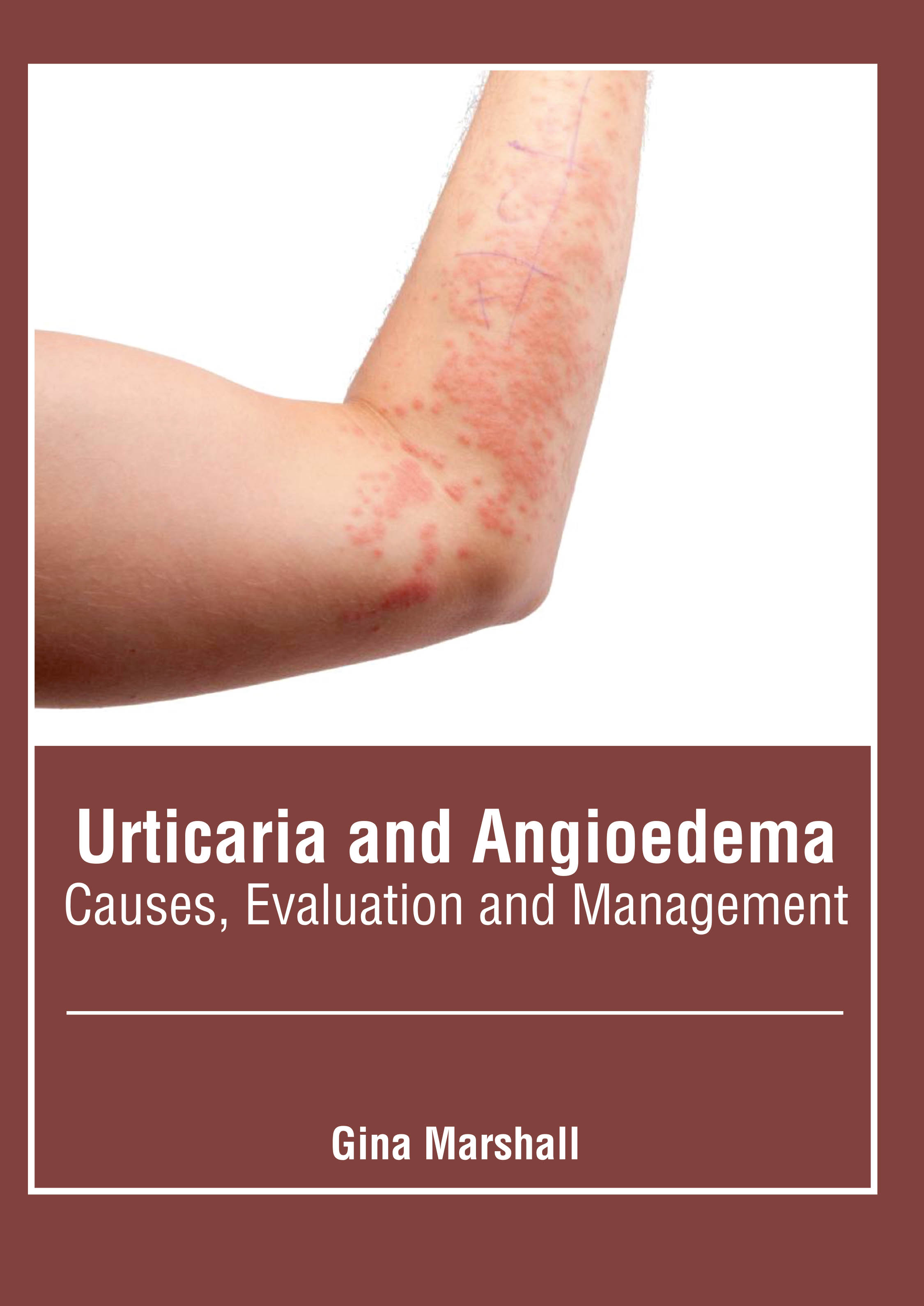 Urticaria and Angioedema: Causes, Evaluation and Management