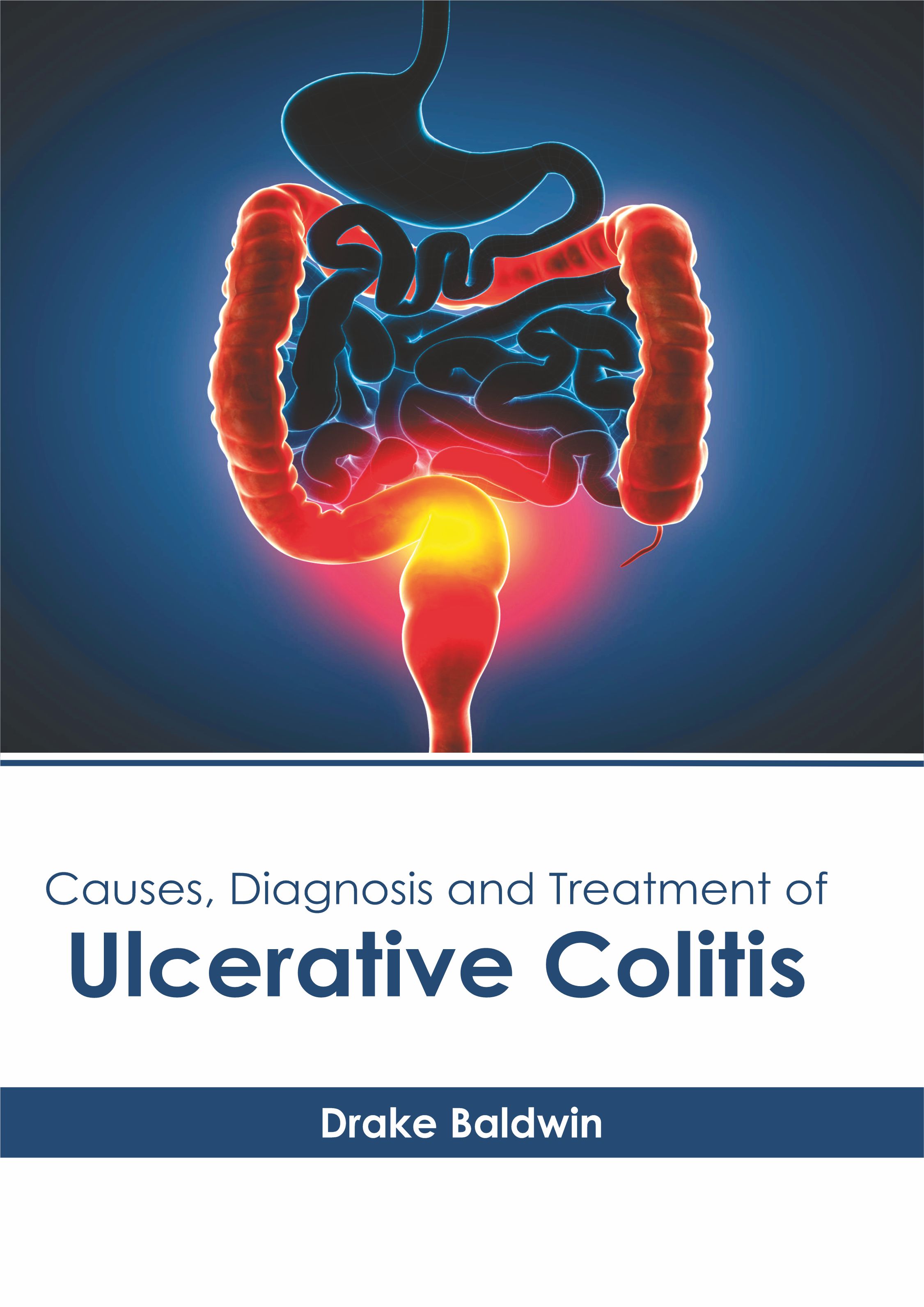 Causes, Diagnosis and Treatment of Ulcerative Colitis