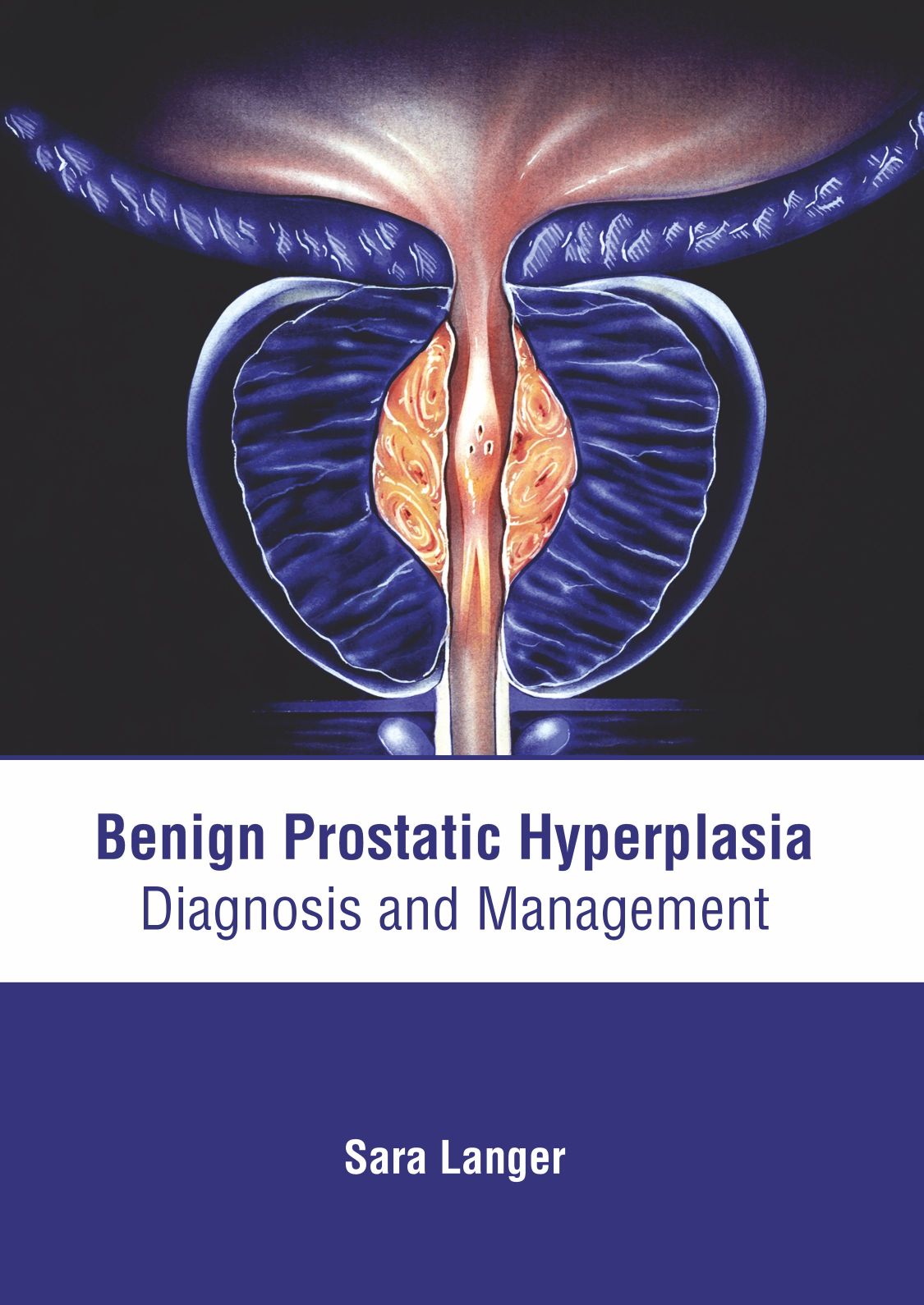 Benign Prostatic Hyperplasia: Diagnosis and Management