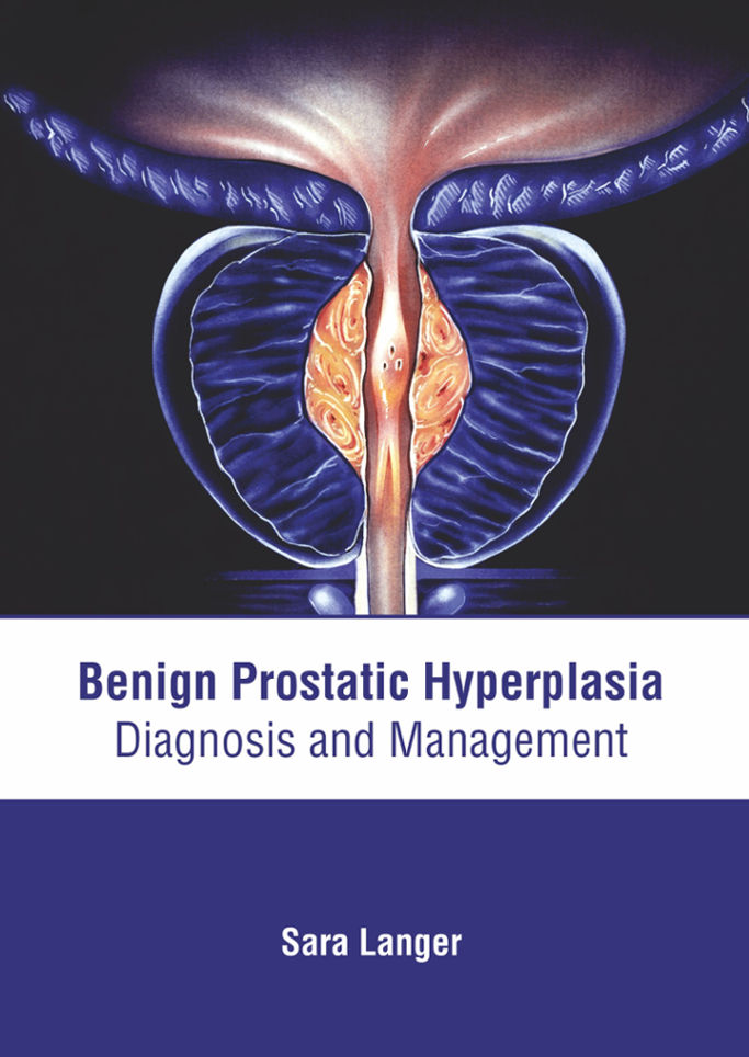 Benign Prostatic Hyperplasia: Diagnosis and Management