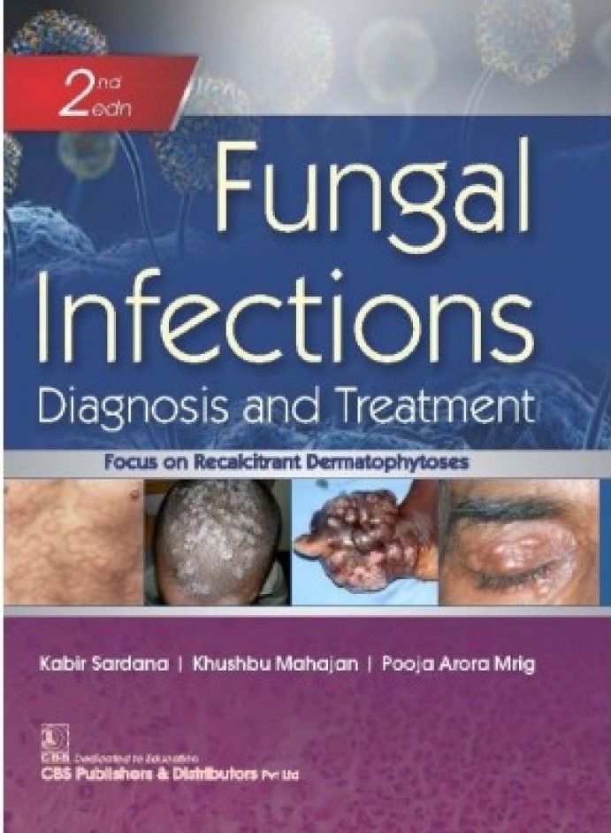 FUNGAL INFECTIONS (DIAGNOSIS AND TREATMENT)